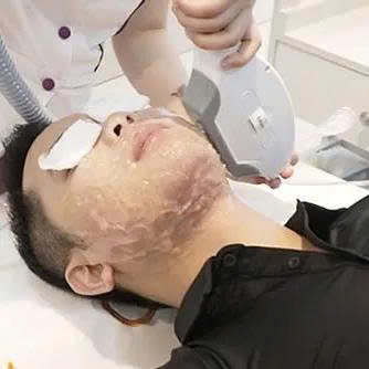 Triệt ria mép nam (8 lần)